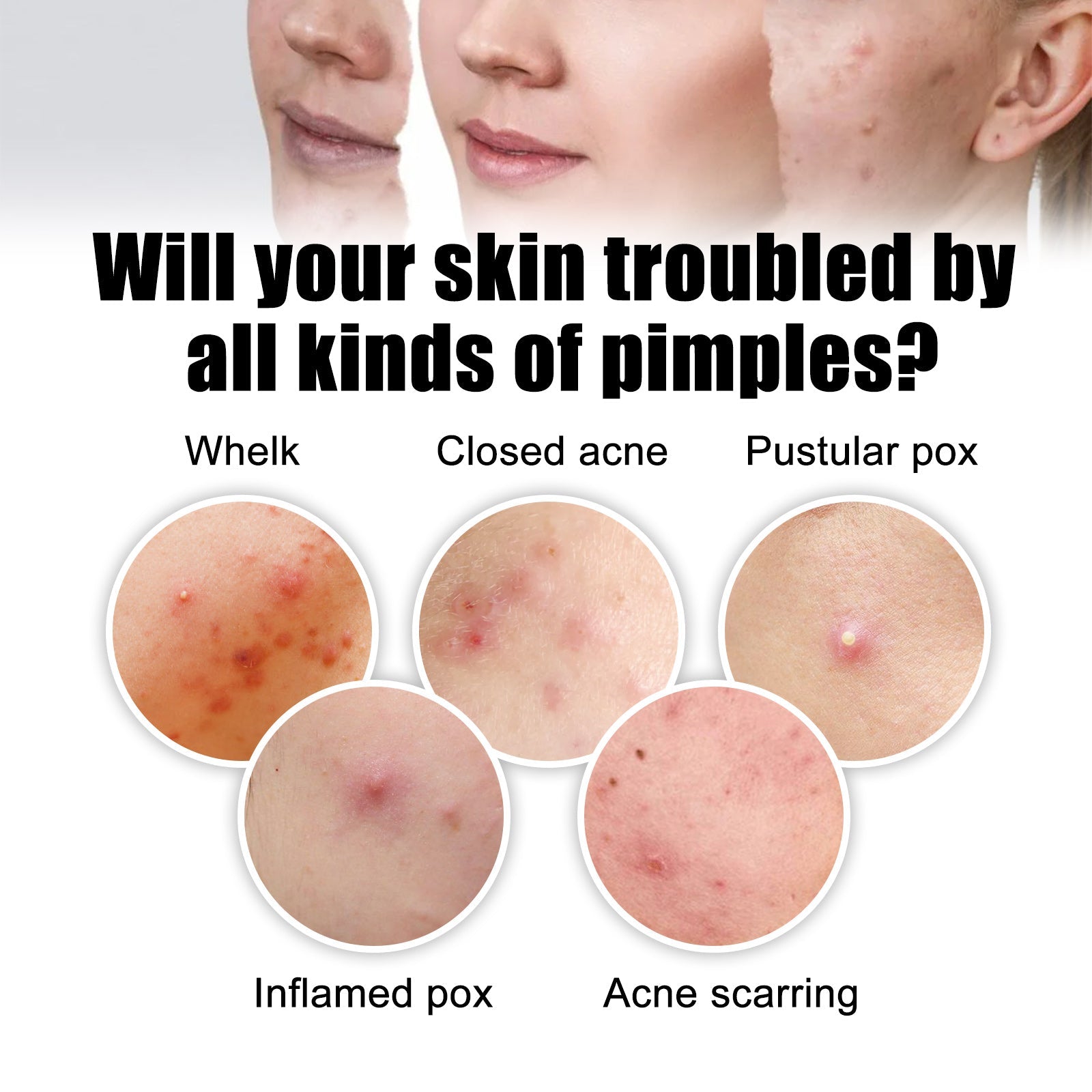 Acne Removal Protection Defense Patch, Color Profile-shaped Portable Invisible Cover Acne Patch