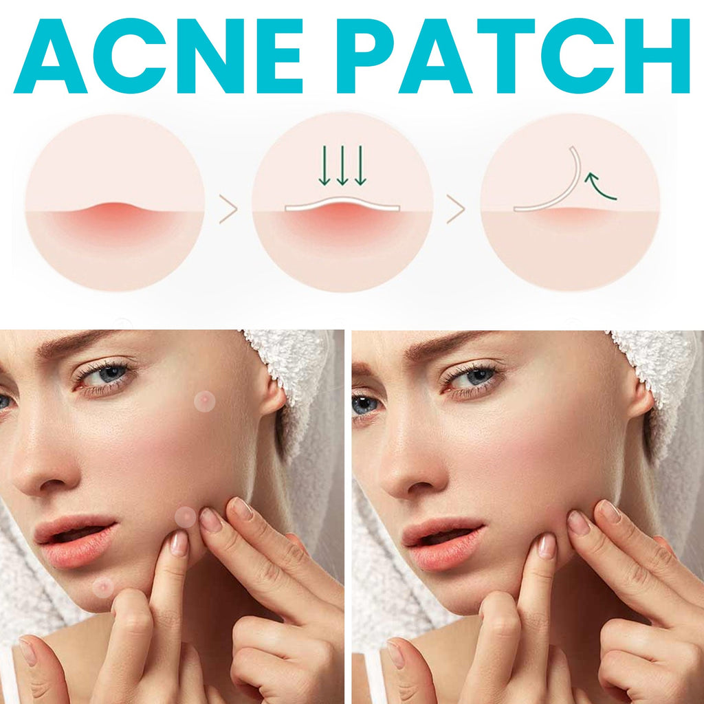 Acne Patch, Repair Facial Acne Invisible Concealer Hydrocolloid Patch