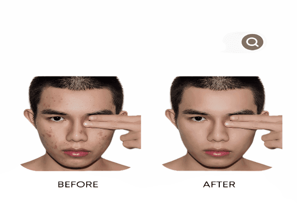 Organic Anti-Acne Three-Step System - Moderate/Severe Acne Prone Skin - For MEN