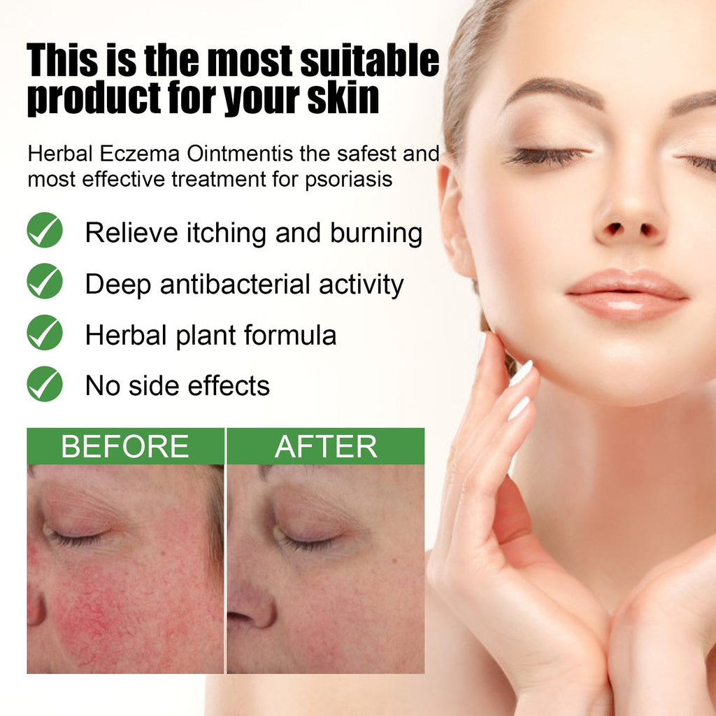 Herbal Eczema Ointment, Relieve Hand And Foot Moss Skin Redness Itchy Skin Repair Ointment